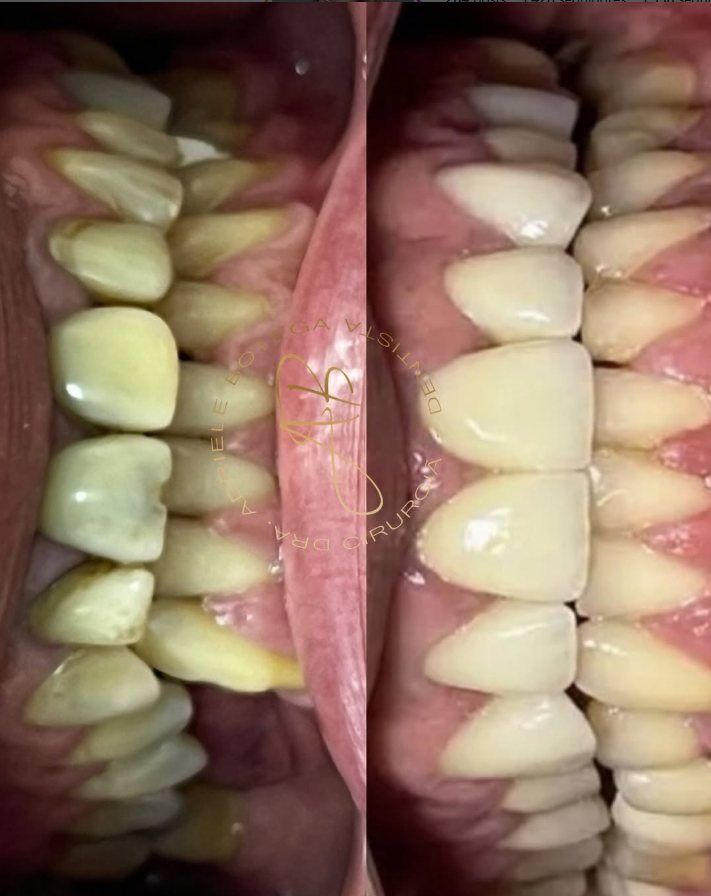 Arcada antes do tratamento, com dentes desgastados e amarelados, e depois da reabilitação, com dentes alinhados e claros